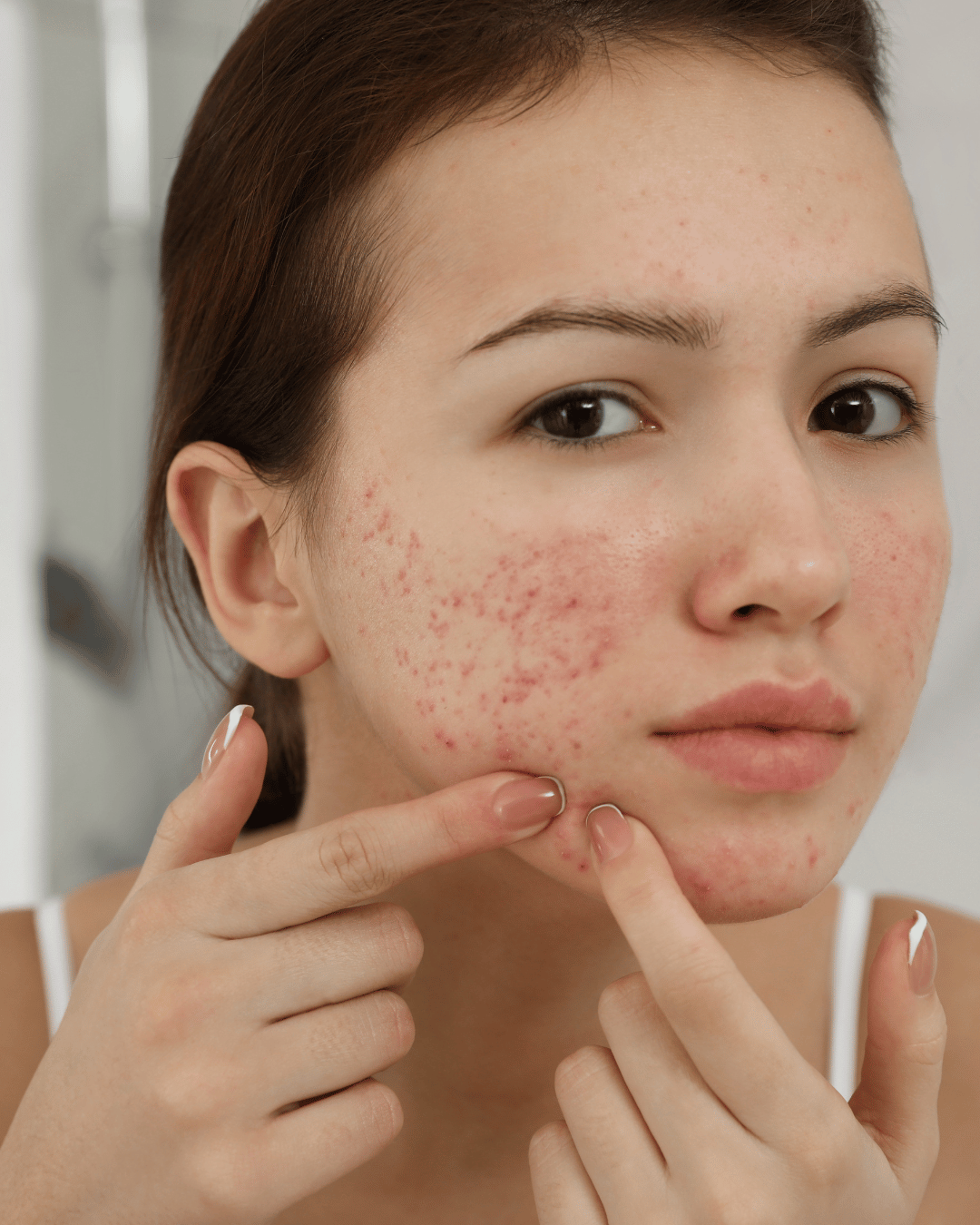 Acne Clear Package
