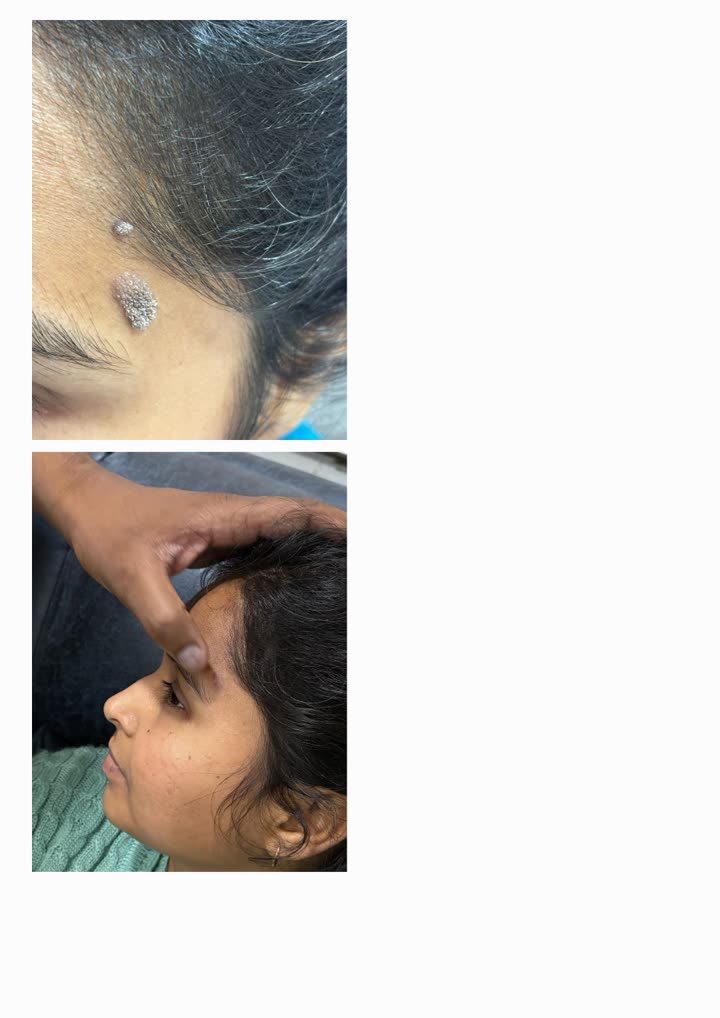 Wart removal before and after at Aesthetic Derm Clinic