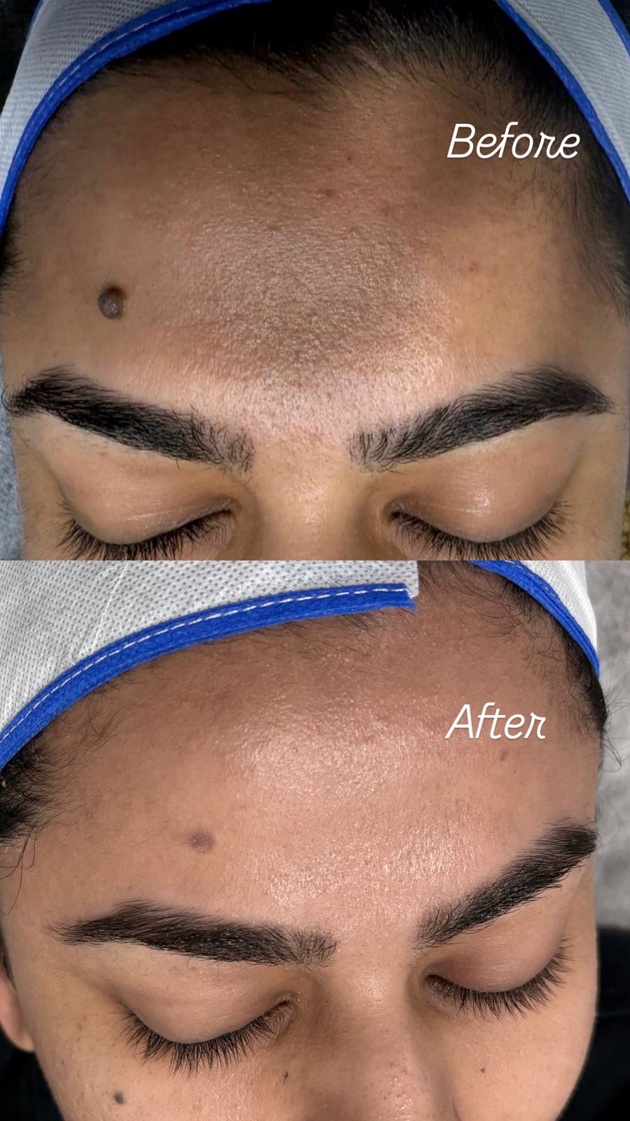 Before and after results at Aesthetic Derm Clinic