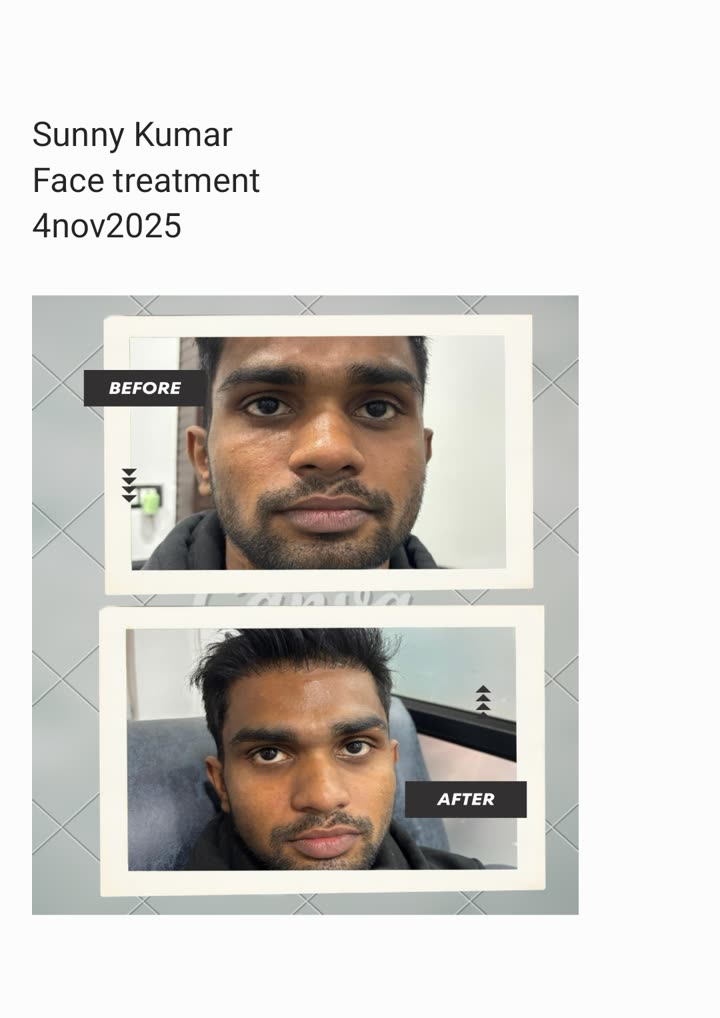 Sunny Kumar face treatment before and after at Aesthetic Derm Clinic