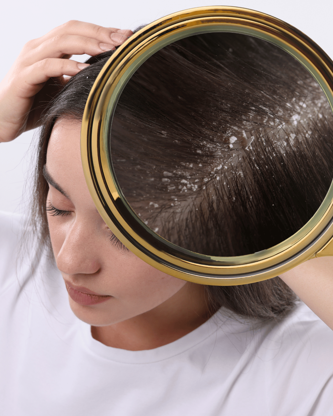 Dandruff Treatment in Delhi